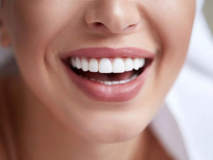 Teeth whitening kits